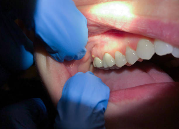 Best Root Canal Emergency Dentist  in Reed City, MI